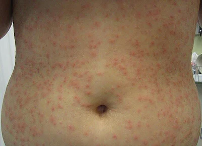 Typical appearance of a Pseudomonas aeruginosa infection.